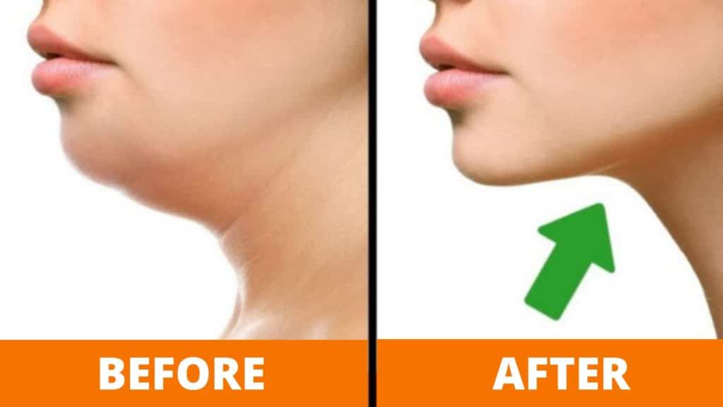 how to get rid of chin fat