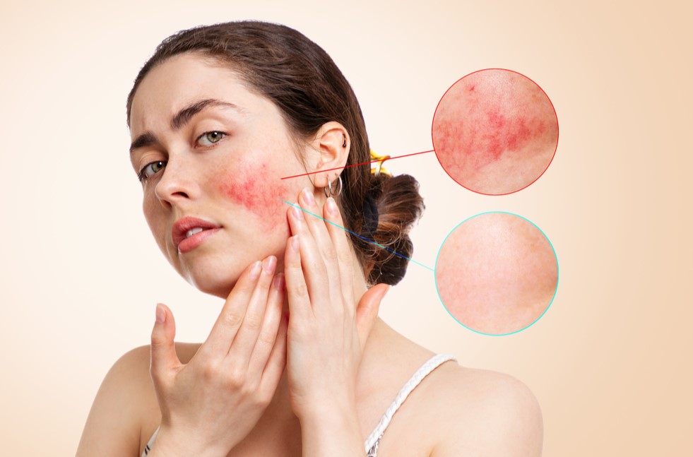 acne-prone sensitive skin