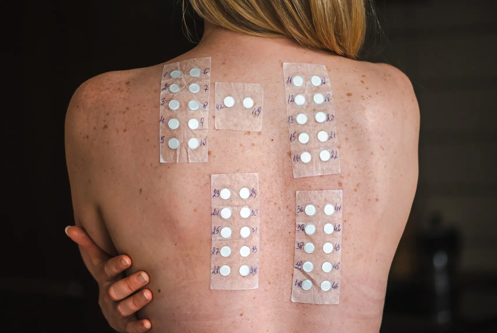 patch testing